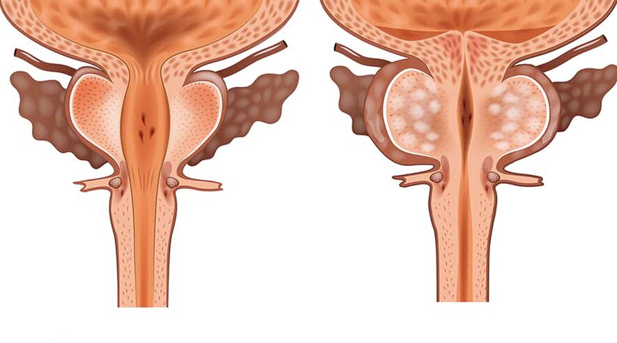 porównanie gruczolaka zdrowego i objętego stanem zapalnym