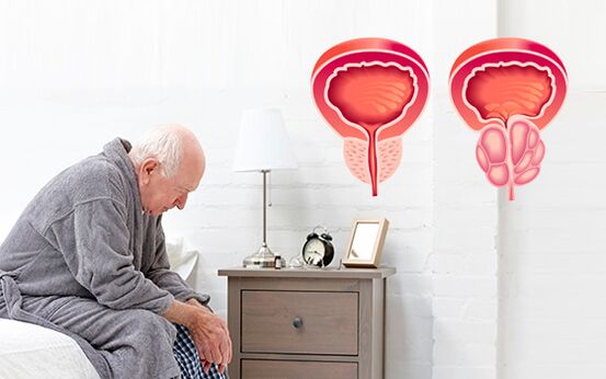 zapalenie prostaty u mężczyzny